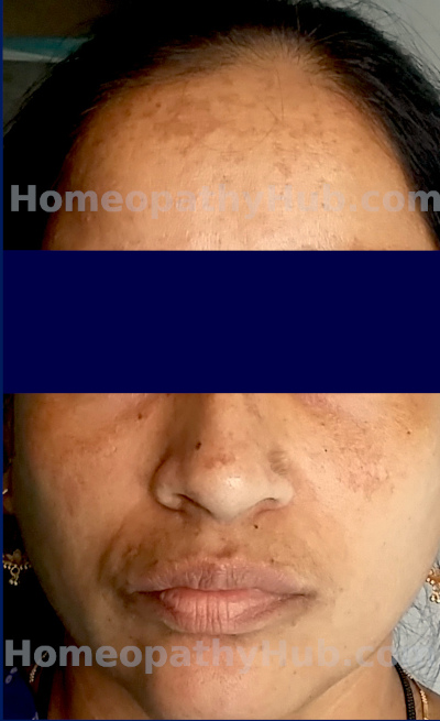 MelasmaWM Melasma homeopathic medicine